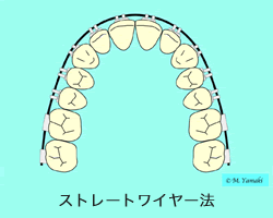 ストレートワイヤー法