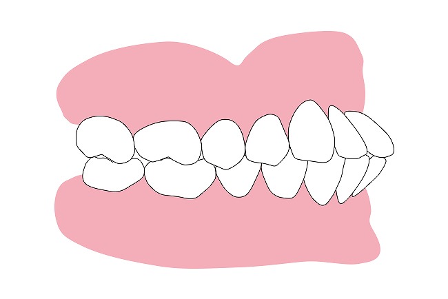 上下の出っ歯（上下顎前突）