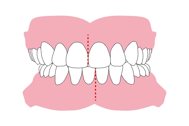 真ん中のずれ（偏位咬合）