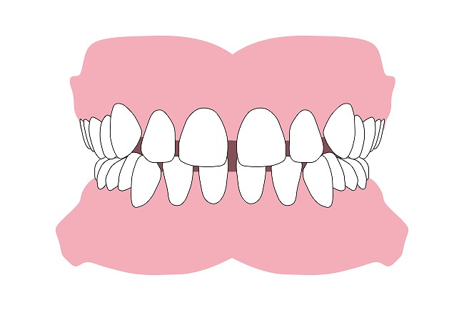 すきっ歯（空隙歯列）